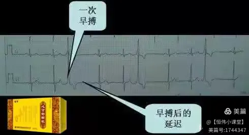 心脏早搏”可怕不可怕，要不要吃药治疗？